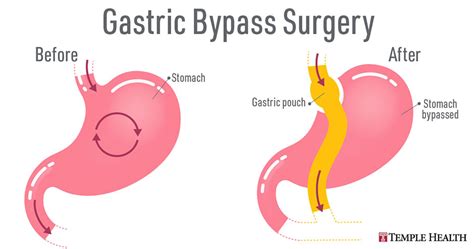 temple bariatric surgery